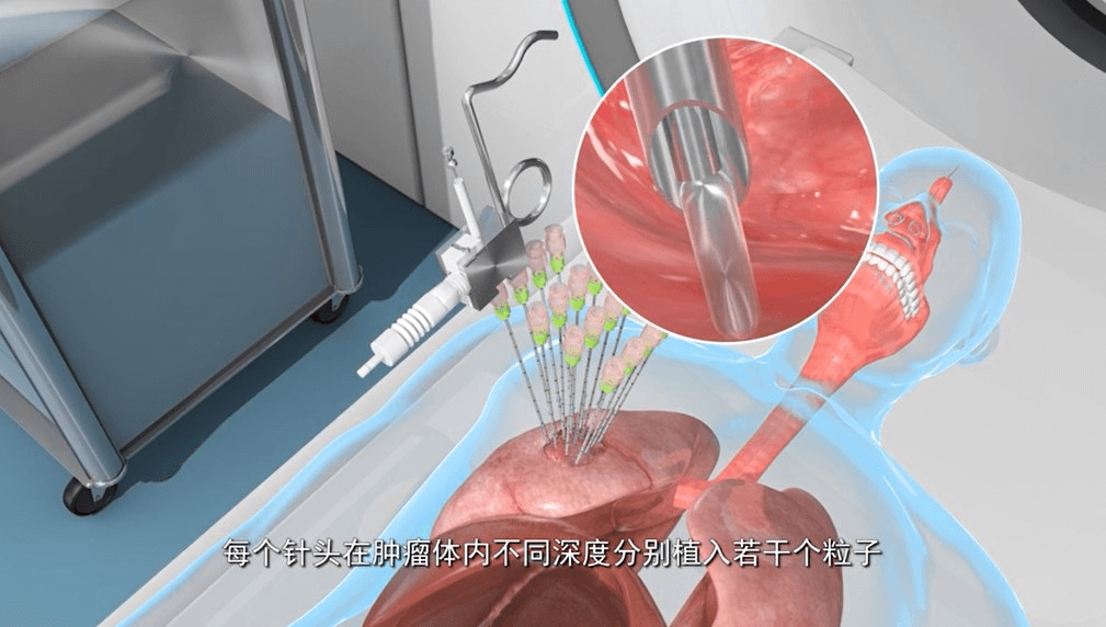 粒子刀療法（Brachytherapy）